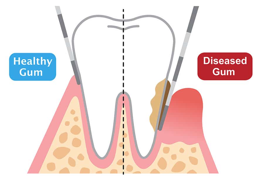 Periodontal Surgery