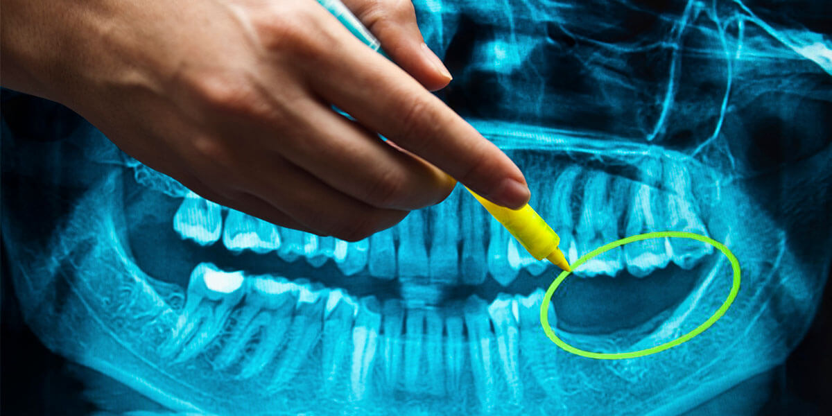 Dental Implant Benefits Photo